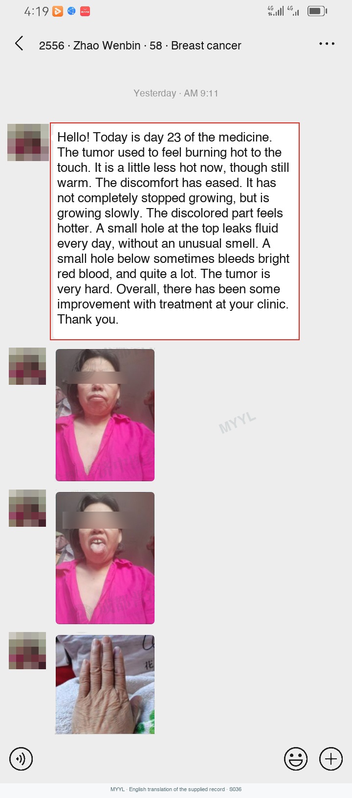 Breast cancer: Less heat and discomfort, with bleeding continuing. English source image 1, with original photographs and clinical records where present.