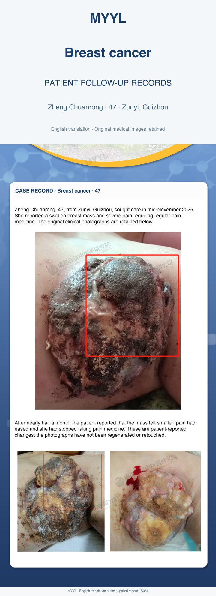 Breast cancer: Reported pain relief after a difficult first visit. English source image 1, with original photographs and clinical records where present.