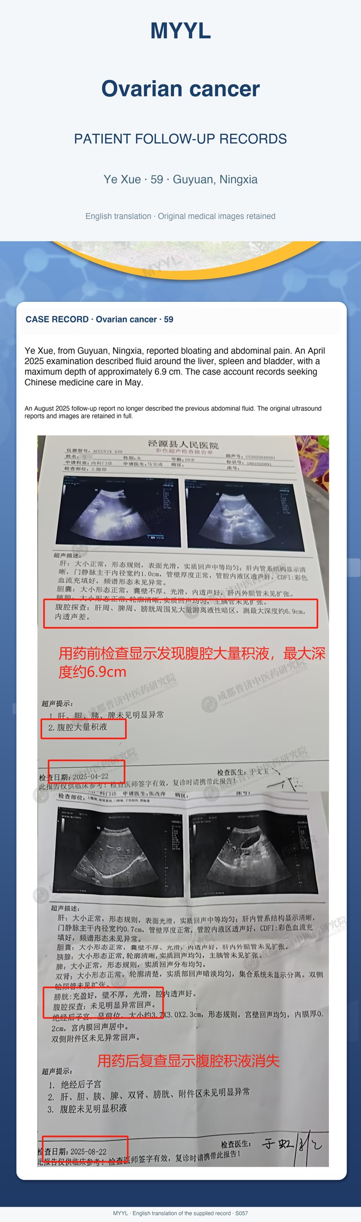 Ovarian cancer: Ascites documented on two ultrasound examinations. English source image 1, with original photographs and clinical records where present.