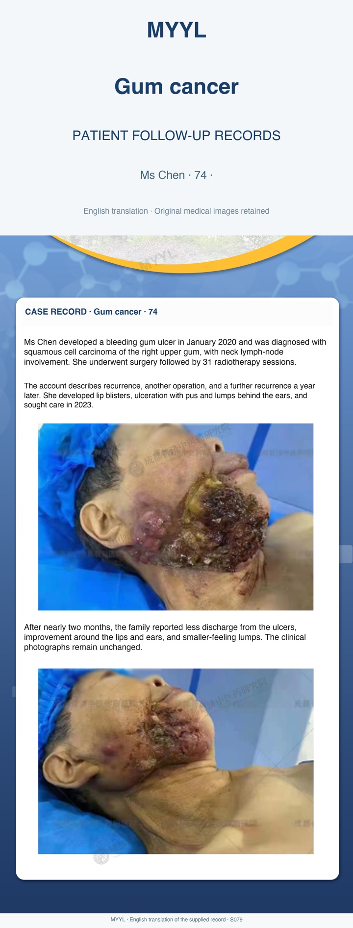 Gum cancer: Wound symptoms after surgery and radiotherapy. English source image 1, with original photographs and clinical records where present.