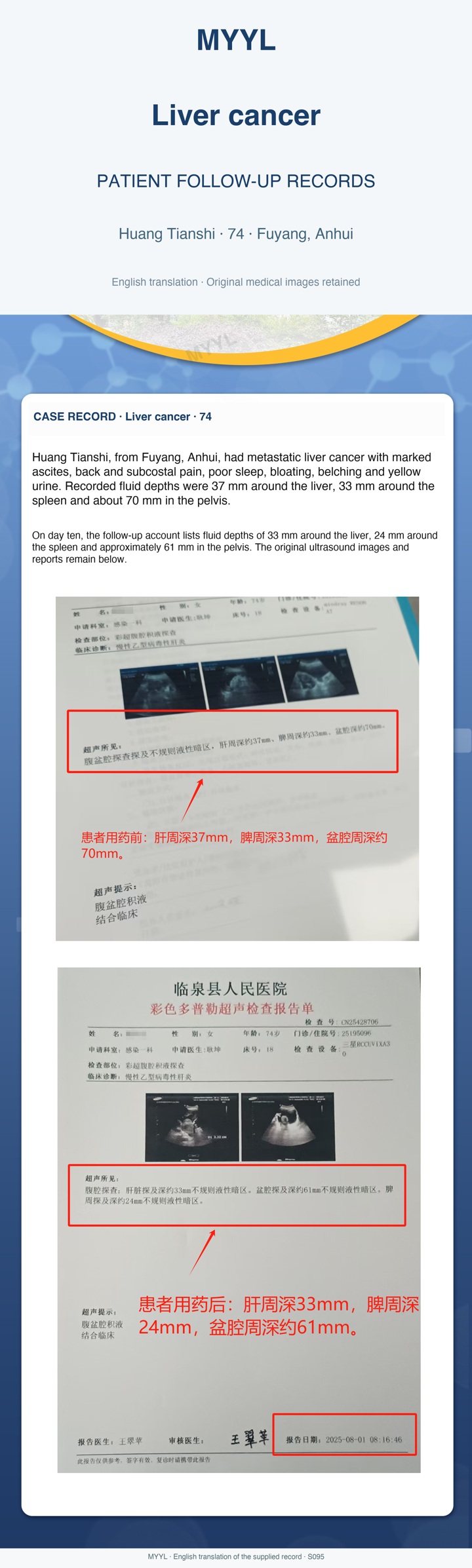 Liver cancer: Ascites measurements at two visits. English source image 1, with original photographs and clinical records where present.